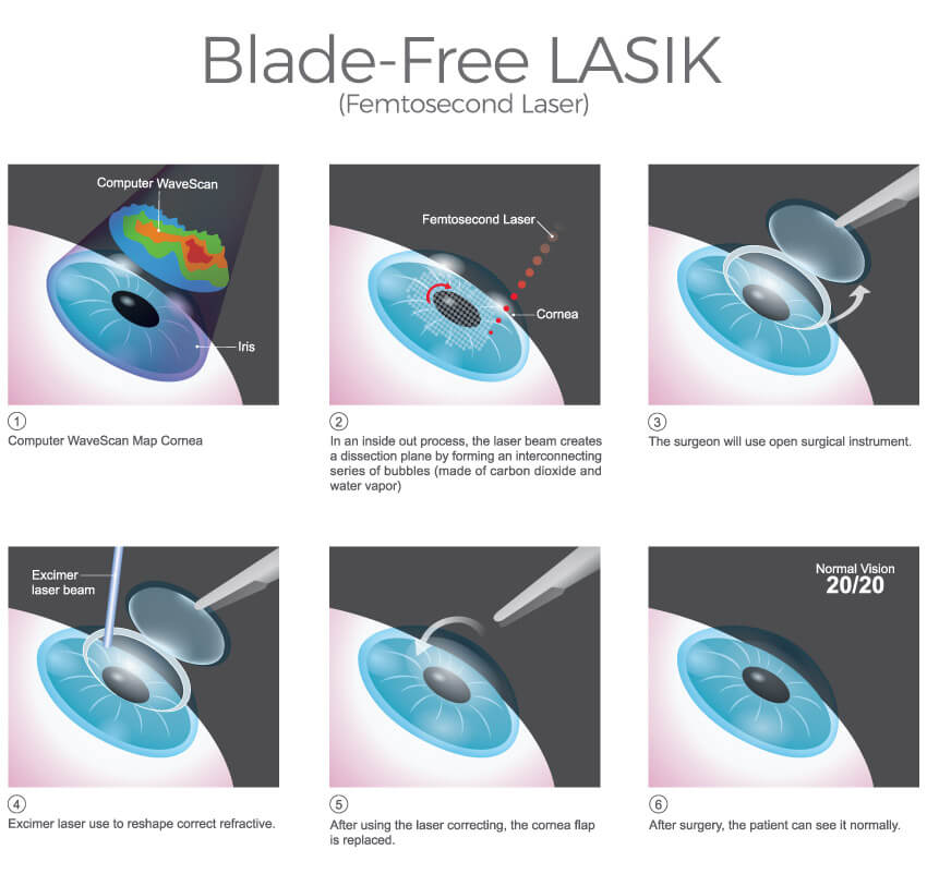 Chart Showing Steps Of Blade-Free LASIK
