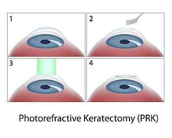 PRK Vision Correction