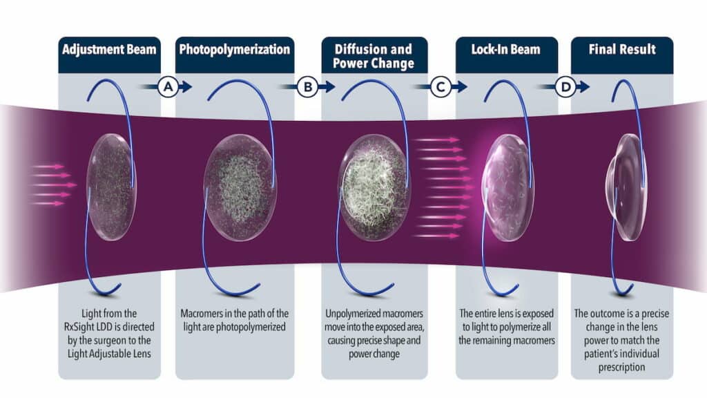 Light Adjustable Lens™ - Mechanism of Action